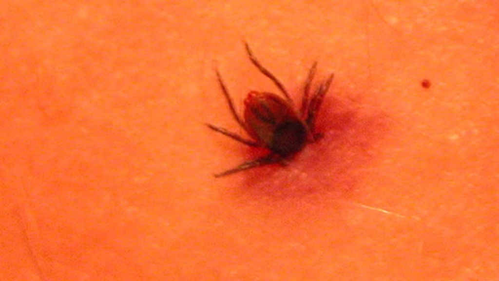 Justin Timberlake Lyme Disease: Causes, Symptoms, Career Impact & Treatment